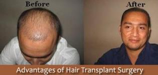 Hair Transplant Surgery Advantages and Disadvantages - Pros & Cons of Hair Growth Method