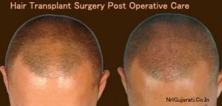 Hair Transplant Surgery Post Operative Care - How to Take Care after Surgery ?