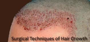 Surgical Techniques of Hair Growth - Clinical Methods Details for Hair / Loss Recovery